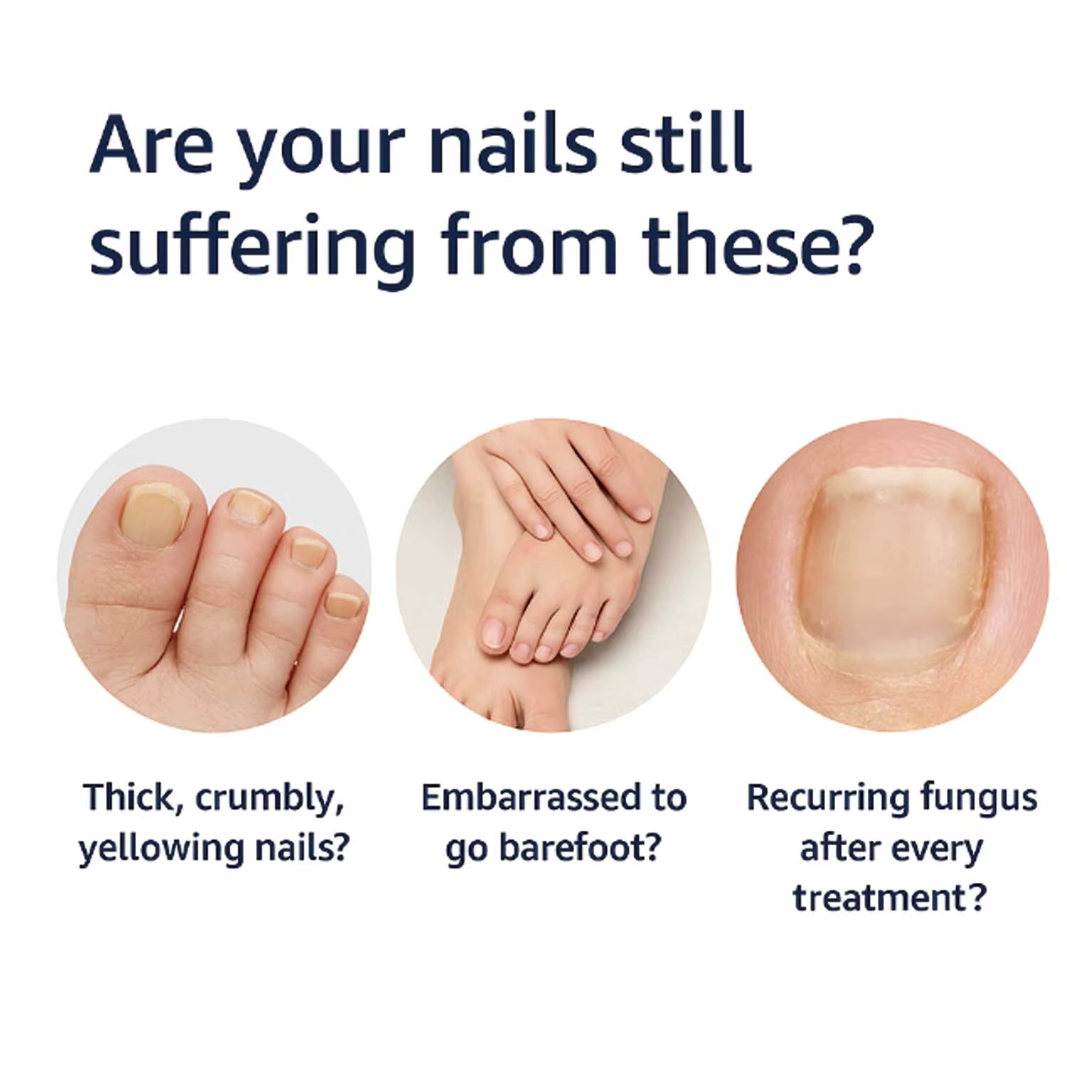 Toenail Fungus Pen UNDECYLENIC ACID 25% - Cures Most Athlete’S Foot, Jock Itch and Ringworm No Filing Required 4 ML Travel Size
